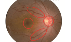 糖尿病视网膜病变成隐形“致盲杀手” 专家称应及时筛查、尽早防治